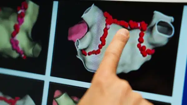 Ablasyon tedavisi: Kalp pili ve şok piline alternatif çözüm